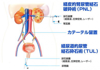 尿管結石の症状の治療方法　経尿道的尿管砕石術
